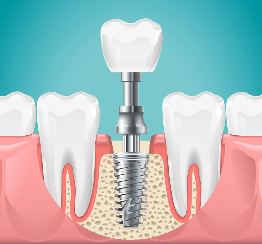 Dental Implants